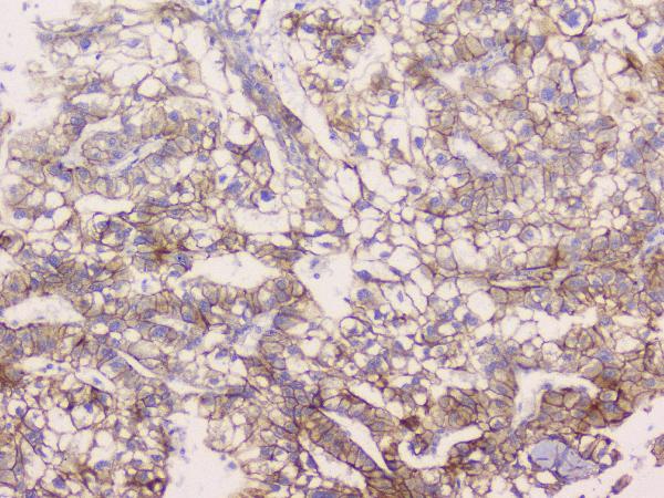 IHC analysis of CTNNB1 using anti-CTNNB1 antibody (A00004). CTNNB1 was detected in paraffin-embedded section of human liver cancer tissue. Heat mediated antigen retrieval was performed in citrate buffer (pH6, epitope retrieval solution) for 20 mins. The tissue section was blocked with 10% goat serum. The tissue section was then incubated with 1μg/ml rabbit anti-CTNNB1 Antibody (A00004) overnight at 4°C. Biotinylated goat anti-rabbit IgG was used as secondary antibody and incubated for 30 minutes at 37°C. The tissue section was developed using Strepavidin-Biotin-Complex (SABC)(Catalog # SA1022) with DAB as the chromogen.