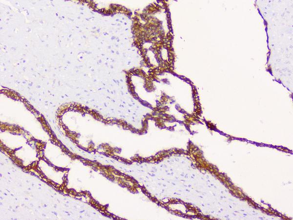 IHC analysis of CTNNB1 using anti-CTNNB1 antibody (A00004). CTNNB1 was detected in paraffin-embedded section of human mammary cancer tissue. Heat mediated antigen retrieval was performed in citrate buffer (pH6, epitope retrieval solution) for 20 mins. The tissue section was blocked with 10% goat serum. The tissue section was then incubated with 1μg/ml rabbit anti-CTNNB1 Antibody (A00004) overnight at 4°C. Biotinylated goat anti-rabbit IgG was used as secondary antibody and incubated for 30 minutes at 37°C. The tissue section was developed using Strepavidin-Biotin-Complex (SABC)(Catalog # SA1022) with DAB as the chromogen.