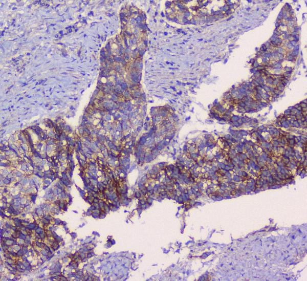 IHC analysis of CTNNB1 using anti-CTNNB1 antibody (A00004). CTNNB1 was detected in paraffin-embedded section of human prostatic cancer tissue. Heat mediated antigen retrieval was performed in citrate buffer (pH6, epitope retrieval solution) for 20 mins. The tissue section was blocked with 10% goat serum. The tissue section was then incubated with 1μg/ml rabbit anti-CTNNB1 Antibody (A00004) overnight at 4°C. Biotinylated goat anti-rabbit IgG was used as secondary antibody and incubated for 30 minutes at 37°C. The tissue section was developed using Strepavidin-Biotin-Complex (SABC)(Catalog # SA1022) with DAB as the chromogen.