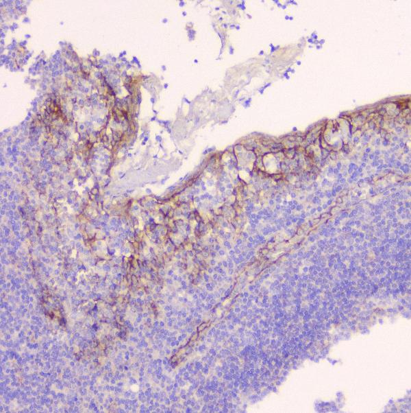 IHC analysis of CTNNB1 using anti-CTNNB1 antibody (A00004). CTNNB1 was detected in paraffin-embedded section of human tonsil tissue. Heat mediated antigen retrieval was performed in citrate buffer (pH6, epitope retrieval solution) for 20 mins. The tissue section was blocked with 10% goat serum. The tissue section was then incubated with 1μg/ml rabbit anti-CTNNB1 Antibody (A00004) overnight at 4°C. Biotinylated goat anti-rabbit IgG was used as secondary antibody and incubated for 30 minutes at 37°C. The tissue section was developed using Strepavidin-Biotin-Complex (SABC)(Catalog # SA1022) with DAB as the chromogen.