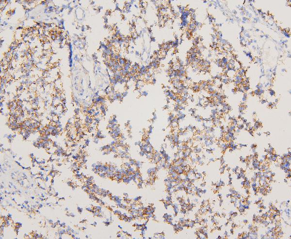 IHC analysis of EGFR using anti-EGFR antibody (A00023). EGFR was detected in paraffin-embedded section of human glioma tissues. Heat mediated antigen retrieval was performed in citrate buffer (pH6, epitope retrieval solution) for 20 mins. The tissue section was blocked with 10% goat serum. The tissue section was then incubated with 1μg/ml rabbit anti-EGFR Antibody (A00023) overnight at 4°C. Biotinylated goat anti-rabbit IgG was used as secondary antibody and incubated for 30 minutes at 37°C. The tissue section was developed using Strepavidin-Biotin-Complex (SABC)(Catalog # SA1022) with DAB as the chromogen.