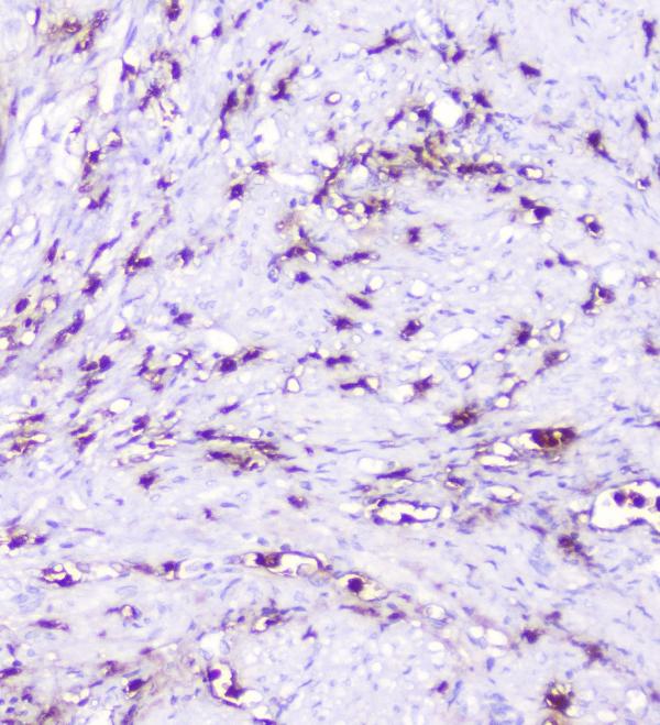 IHC analysis of CXCL12 using anti-CXCL12 antibody (A00053-2). CXCL12 was detected in paraffin-embedded section of human endometrial carcinoma tissue. Heat mediated antigen retrieval was performed in citrate buffer (pH6, epitope retrieval solution) for 20 mins. The tissue section was blocked with 10% goat serum. The tissue section was then incubated with 1μg/ml rabbit anti-CXCL12 Antibody (A00053-2) overnight at 4°C. Biotinylated goat anti-rabbit IgG was used as secondary antibody and incubated for 30 minutes at 37°C. The tissue section was developed using Strepavidin-Biotin-Complex (SABC)(Catalog # SA1022) with DAB as the chromogen.