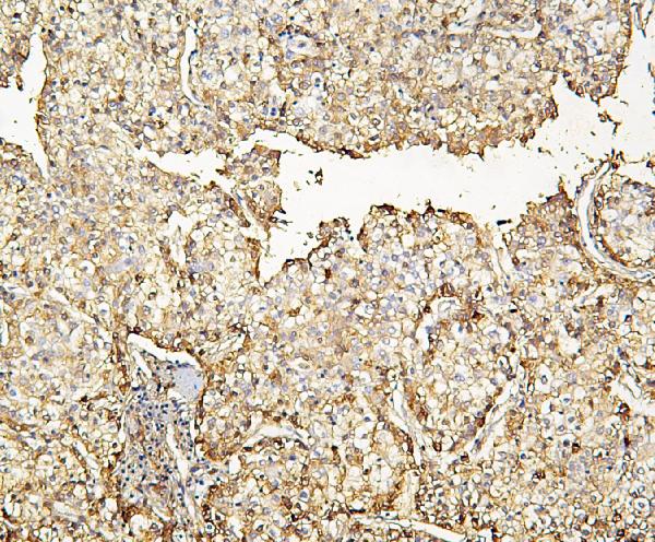 IHC analysis of HP using anti-HP antibody (A00062-1). HP was detected in paraffin-embedded section of human liver cancer tissue. Heat mediated antigen retrieval was performed in citrate buffer (pH6, epitope retrieval solution) for 20 mins. The tissue section was blocked with 10% goat serum. The tissue section was then incubated with 1μg/ml rabbit anti-HP Antibody (A00062-1) overnight at 4°C. Biotinylated goat anti-rabbit IgG was used as secondary antibody and incubated for 30 minutes at 37°C. The tissue section was developed using Strepavidin-Biotin-Complex (SABC)(Catalog # SA1022) with DAB as the chromogen.