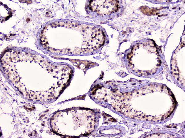 IHC analysis of Rad51 using anti-Rad51 antibody (A00088). Rad51 was detected in paraffin-embedded section of human testis tissue. Heat mediated antigen retrieval was performed in citrate buffer (pH6, epitope retrieval solution) for 20 mins. The tissue section was blocked with 10% goat serum. The tissue section was then incubated with 1μg/ml rabbit anti-Rad51 Antibody (A00088) overnight at 4°C. Biotinylated goat anti-rabbit IgG was used as secondary antibody and incubated for 30 minutes at 37°C. The tissue section was developed using Strepavidin-Biotin-Complex (SABC)(Catalog # SA1022) with DAB as the chromogen.