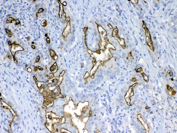 IHC analysis of MUC1 using anti-MUC1 antibody (A00187).