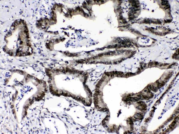 IHC analysis of Ran using anti-Ran antibody (A00204-1). Ran was detected in paraffin-embedded section of human intestinal cancer tissue. Heat mediated antigen retrieval was performed in citrate buffer (pH6, epitope retrieval solution) for 20 mins. The tissue section was blocked with 10% goat serum. The tissue section was then incubated with 1μg/ml rabbit anti-Ran Antibody (A00204-1) overnight at 4°C. Biotinylated goat anti-rabbit IgG was used as secondary antibody and incubated for 30 minutes at 37°C. The tissue section was developed using Strepavidin-Biotin-Complex (SABC)(Catalog # SA1022) with DAB as the chromogen.