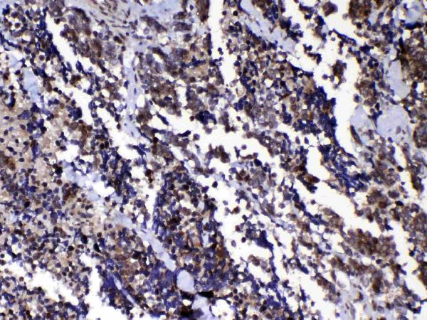 IHC analysis of Ran using anti-Ran antibody (A00204-1). Ran was detected in paraffin-embedded section of human lung cancer tissue. Heat mediated antigen retrieval was performed in citrate buffer (pH6, epitope retrieval solution) for 20 mins. The tissue section was blocked with 10% goat serum. The tissue section was then incubated with 1μg/ml rabbit anti-Ran Antibody (A00204-1) overnight at 4°C. Biotinylated goat anti-rabbit IgG was used as secondary antibody and incubated for 30 minutes at 37°C. The tissue section was developed using Strepavidin-Biotin-Complex (SABC)(Catalog # SA1022) with DAB as the chromogen.