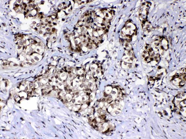 IHC analysis of Ran using anti-Ran antibody (A00204-1). Ran was detected in paraffin-embedded section of human mammary cancer tissue. Heat mediated antigen retrieval was performed in citrate buffer (pH6, epitope retrieval solution) for 20 mins. The tissue section was blocked with 10% goat serum. The tissue section was then incubated with 1μg/ml rabbit anti-Ran Antibody (A00204-1) overnight at 4°C. Biotinylated goat anti-rabbit IgG was used as secondary antibody and incubated for 30 minutes at 37°C. The tissue section was developed using Strepavidin-Biotin-Complex (SABC)(Catalog # SA1022) with DAB as the chromogen.