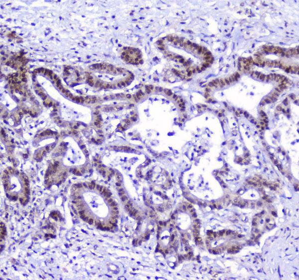 IHC analysis of AHR using anti-AHR antibody (A00225-2). AHR was detected in paraffin-embedded section of human cholangiocarcinoma tissue. Heat mediated antigen retrieval was performed in citrate buffer (pH6, epitope retrieval solution) for 20 mins. The tissue section was blocked with 10% goat serum. The tissue section was then incubated with 2μg/ml rabbit anti-AHR Antibody (A00225-2) overnight at 4°C. Biotinylated goat anti-rabbit IgG was used as secondary antibody and incubated for 30 minutes at 37°C. The tissue section was developed using Strepavidin-Biotin-Complex (SABC)(Catalog # SA1022) with DAB as the chromogen.