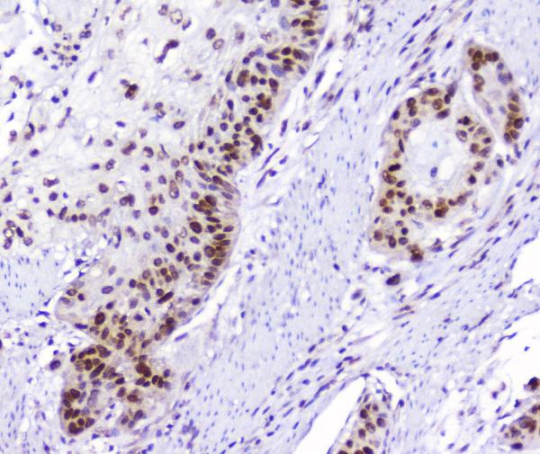 IHC analysis of AHR using anti-AHR antibody (A00225-2). AHR was detected in paraffin-embedded section of human oesophagus squama cancer tissue. Heat mediated antigen retrieval was performed in citrate buffer (pH6, epitope retrieval solution) for 20 mins. The tissue section was blocked with 10% goat serum. The tissue section was then incubated with 2μg/ml rabbit anti-AHR Antibody (A00225-2) overnight at 4°C. Biotinylated goat anti-rabbit IgG was used as secondary antibody and incubated for 30 minutes at 37°C. The tissue section was developed using Strepavidin-Biotin-Complex (SABC)(Catalog # SA1022) with DAB as the chromogen.