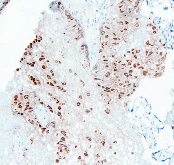 IHC analysis of PTP1B using anti-PTP1B antibody (A00613-1). PTP1B was detected in frozen section of human placenta tissues. The tissue section was blocked with 10% goat serum. The tissue section was then incubated with 1μg/ml rabbit anti-PTP1B Antibody (A00613-1) overnight at 4°C. Biotinylated goat anti-rabbit IgG was used as secondary antibody and incubated for 30 minutes at 37°C. The tissue section was developed using Strepavidin-Biotin-Complex (SABC)(Catalog # SA1022) with DAB as the chromogen.