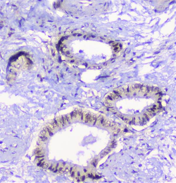 IHC analysis of CFP using anti-CFP antibody (A00852-2). CFP was detected in paraffin-embedded section of human cholangiocarcinoma tissue. Heat mediated antigen retrieval was performed in citrate buffer (pH6, epitope retrieval solution) for 20 mins. The tissue section was blocked with 10% goat serum. The tissue section was then incubated with 1μg/ml rabbit anti-CFP Antibody (A00852-2) overnight at 4°C. Biotinylated goat anti-rabbit IgG was used as secondary antibody and incubated for 30 minutes at 37°C. The tissue section was developed using Strepavidin-Biotin-Complex (SABC)(Catalog # SA1022) with DAB as the chromogen.