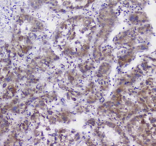 IHC analysis of CFP using anti-CFP antibody (A00852-2). CFP was detected in paraffin-embedded section of human liver cancer tissue. Heat mediated antigen retrieval was performed in citrate buffer (pH6, epitope retrieval solution) for 20 mins. The tissue section was blocked with 10% goat serum. The tissue section was then incubated with 1μg/ml rabbit anti-CFP Antibody (A00852-2) overnight at 4°C. Biotinylated goat anti-rabbit IgG was used as secondary antibody and incubated for 30 minutes at 37°C. The tissue section was developed using Strepavidin-Biotin-Complex (SABC)(Catalog # SA1022) with DAB as the chromogen.