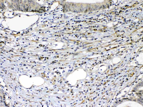 IHC analysis of VEGF Receptor 2 using anti-VEGF Receptor 2 antibody (A00901-2). VEGF Receptor 2 was detected in paraffin-embedded section of human intestinal cancer tissue. Heat mediated antigen retrieval was performed in citrate buffer (pH6, epitope retrieval solution) for 20 mins. The tissue section was blocked with 10% goat serum. The tissue section was then incubated with 1ug/ml rabbit anti-VEGF Receptor 2 Antibody (A00901-2) overnight at 4 Biotinylated goat anti-rabbit IgG was used as secondary antibody and incubated for 30 minutes at 37 The tissue section was developed using Strepavidin-Biotin-Complex (SABC)(Catalog # SA1022) with DAB as the chromogen.