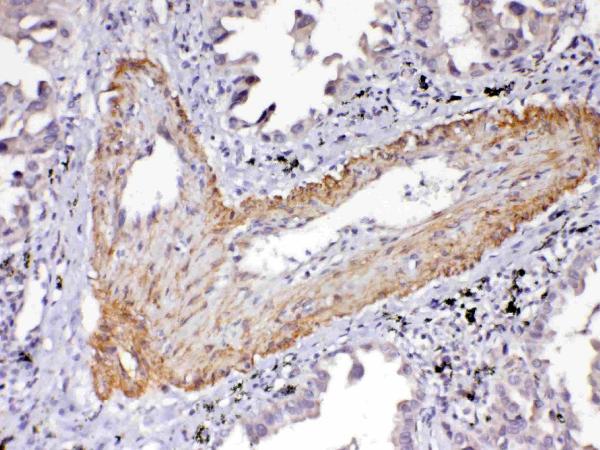 IHC analysis of VEGF Receptor 2 using anti-VEGF Receptor 2 antibody (A00901-2). VEGF Receptor 2 was detected in paraffin-embedded section of human lung cancer tissue. Heat mediated antigen retrieval was performed in citrate buffer (pH6, epitope retrieval solution) for 20 mins. The tissue section was blocked with 10% goat serum. The tissue section was then incubated with 1ug/ml rabbit anti-VEGF Receptor 2 Antibody (A00901-2) overnight at 4 Biotinylated goat anti-rabbit IgG was used as secondary antibody and incubated for 30 minutes at 37 The tissue section was developed using Strepavidin-Biotin-Complex (SABC)(Catalog # SA1022) with DAB as the chromogen.