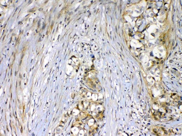 IHC analysis of VEGF Receptor 2 using anti-VEGF Receptor 2 antibody (A00901-2). VEGF Receptor 2 was detected in paraffin-embedded section of human mammary cancer tissue. Heat mediated antigen retrieval was performed in citrate buffer (pH6, epitope retrieval solution) for 20 mins. The tissue section was blocked with 10% goat serum. The tissue section was then incubated with 1ug/ml rabbit anti-VEGF Receptor 2 Antibody (A00901-2) overnight at 4 Biotinylated goat anti-rabbit IgG was used as secondary antibody and incubated for 30 minutes at 37 The tissue section was developed using Strepavidin-Biotin-Complex (SABC)(Catalog # SA1022) with DAB as the chromogen.