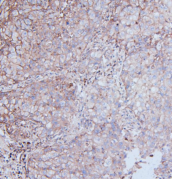 IHC analysis of DDR1 using anti-DDR1 antibody (A00905). DDR1 was detected in paraffin-embedded section of human Lung cancer tissues. Heat mediated antigen retrieval was performed in citrate buffer (pH6, epitope retrieval solution) for 20 mins. The tissue section was blocked with 10% goat serum. The tissue section was then incubated with 1μg/ml rabbit anti-DDR1 Antibody (A00905) overnight at 4°C. Biotinylated goat anti-rabbit IgG was used as secondary antibody and incubated for 30 minutes at 37°C. The tissue section was developed using Strepavidin-Biotin-Complex (SABC)(Catalog # SA1022) with DAB as the chromogen.