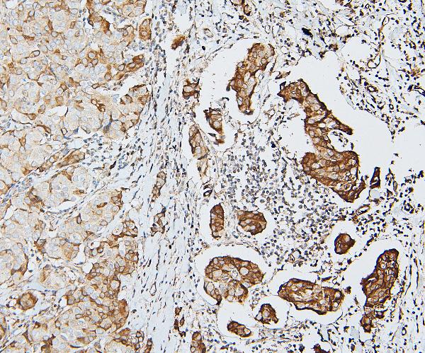 IHC analysis of DDR1 using anti-DDR1 antibody (A00905). DDR1 was detected in paraffin-embedded section of human mammary cancer tissues. Heat mediated antigen retrieval was performed in citrate buffer (pH6, epitope retrieval solution) for 20 mins. The tissue section was blocked with 10% goat serum. The tissue section was then incubated with 1μg/ml rabbit anti-DDR1 Antibody (A00905) overnight at 4°C. Biotinylated goat anti-rabbit IgG was used as secondary antibody and incubated for 30 minutes at 37°C. The tissue section was developed using Strepavidin-Biotin-Complex (SABC)(Catalog # SA1022) with DAB as the chromogen.