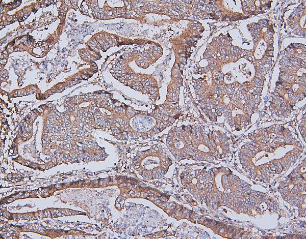 IHC analysis of DDR1 using anti-DDR1 antibody (A00905). DDR1 was detected in paraffin-embedded section of human rectal cancer tissues. Heat mediated antigen retrieval was performed in citrate buffer (pH6, epitope retrieval solution) for 20 mins. The tissue section was blocked with 10% goat serum. The tissue section was then incubated with 1μg/ml rabbit anti-DDR1 Antibody (A00905) overnight at 4°C. Biotinylated goat anti-rabbit IgG was used as secondary antibody and incubated for 30 minutes at 37°C. The tissue section was developed using Strepavidin-Biotin-Complex (SABC)(Catalog # SA1022) with DAB as the chromogen.