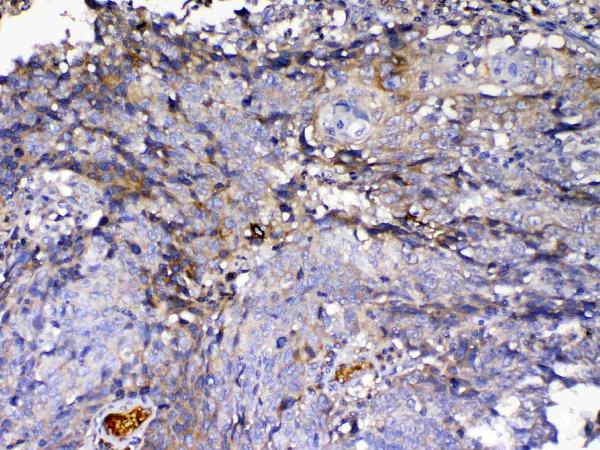 IHC analysis of IGFBP2 using anti-IGFBP2 antibody (A01373-1). IGFBP2 was detected in paraffin-embedded section of human lung cancer tissue. Heat mediated antigen retrieval was performed in citrate buffer (pH6, epitope retrieval solution) for 20 mins. The tissue section was blocked with 10% goat serum. The tissue section was then incubated with 1ug/ml rabbit anti-IGFBP2 Antibody (A01373-1) overnight at 4 Biotinylated goat anti-rabbit IgG was used as secondary antibody and incubated for 30 minutes at 37 The tissue section was developed using Strepavidin-Biotin-Complex (SABC)(Catalog # SA1022) with DAB as the chromogen.