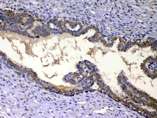 IHC analysis of IGFBP2 using anti-IGFBP2 antibody (A01373-1). IGFBP2 was detected in paraffin-embedded section of human mammary cancer tissue. Heat mediated antigen retrieval was performed in citrate buffer (pH6, epitope retrieval solution) for 20 mins. The tissue section was blocked with 10% goat serum. The tissue section was then incubated with 1ug/ml rabbit anti-IGFBP2 Antibody (A01373-1) overnight at 4 Biotinylated goat anti-rabbit IgG was used as secondary antibody and incubated for 30 minutes at 37 The tissue section was developed using Strepavidin-Biotin-Complex (SABC)(Catalog # SA1022) with DAB as the chromogen.