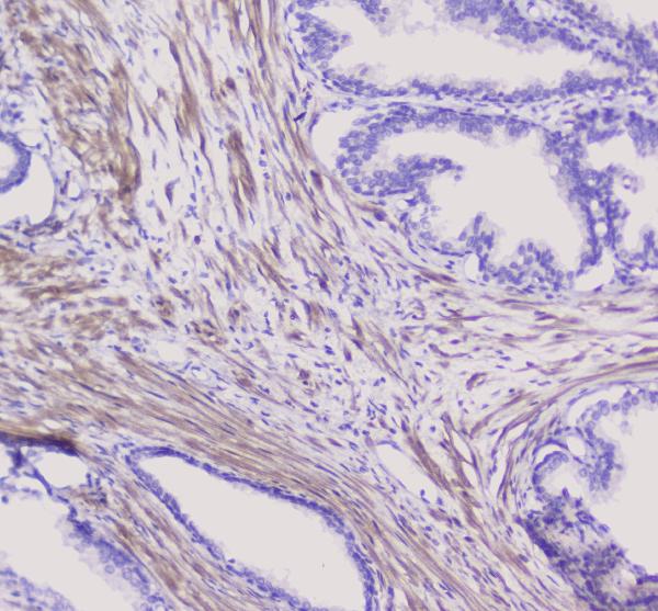 IHC analysis of NSE using anti-NSE antibody (A02930). NSE was detected in paraffin-embedded section of human pancreatic cancer tissue. Heat mediated antigen retrieval was performed in citrate buffer (pH6, epitope retrieval solution) for 20 mins. The tissue section was blocked with 10% goat serum. The tissue section was then incubated with 1μg/ml rabbit anti-NSE Antibody (A02930) overnight at 4°C. Biotinylated goat anti-rabbit IgG was used as secondary antibody and incubated for 30 minutes at 37°C. The tissue section was developed using Strepavidin-Biotin-Complex (SABC)(Catalog # SA1022) with DAB as the chromogen.