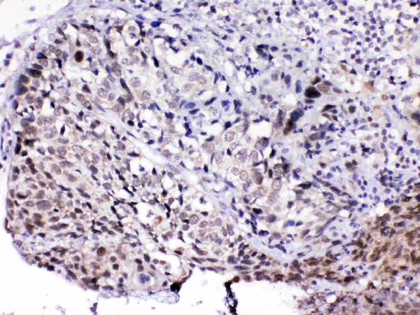 IHC analysis of MED15 using anti-MED15 antibody (A03568-1). MED15 was detected in paraffin-embedded section of human lung cancer tissue. Heat mediated antigen retrieval was performed in citrate buffer (pH6, epitope retrieval solution) for 20 mins. The tissue section was blocked with 10% goat serum. The tissue section was then incubated with 1ug/ml rabbit anti-MED15 Antibody (A03568-1) overnight at 4 Biotinylated goat anti-rabbit IgG was used as secondary antibody and incubated for 30 minutes at 37 The tissue section was developed using Strepavidin-Biotin-Complex (SABC)(Catalog # SA1022) with DAB as the chromogen.