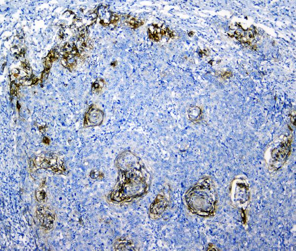 IHC analysis of SLC34A2 using anti-SLC34A2 antibody (A03957-1). SLC34A2 was detected in paraffin-embedded section of human lung cancer tissue. Heat mediated antigen retrieval was performed in citrate buffer (pH6, epitope retrieval solution) for 20 mins. The tissue section was blocked with 10% goat serum. The tissue section was then incubated with 1μg/ml rabbit anti-SLC34A2 Antibody (A03957-1) overnight at 4°C. Biotinylated goat anti-rabbit IgG was used as secondary antibody and incubated for 30 minutes at 37°C. The tissue section was developed using Strepavidin-Biotin-Complex (SABC)(Catalog # SA1022) with DAB as the chromogen.