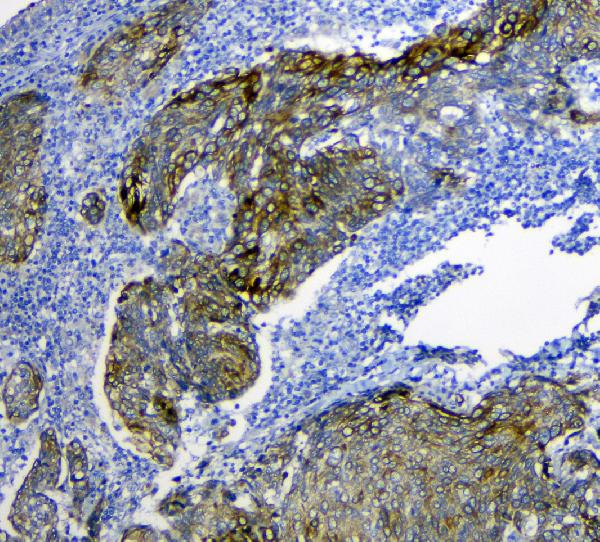 IHC analysis of SLC34A2 using anti-SLC34A2 antibody (A03957-1). SLC34A2 was detected in paraffin-embedded section of human lung cancer tissue. Heat mediated antigen retrieval was performed in citrate buffer (pH6, epitope retrieval solution) for 20 mins. The tissue section was blocked with 10% goat serum. The tissue section was then incubated with 1μg/ml rabbit anti-SLC34A2 Antibody (A03957-1) overnight at 4°C. Biotinylated goat anti-rabbit IgG was used as secondary antibody and incubated for 30 minutes at 37°C. The tissue section was developed using Strepavidin-Biotin-Complex (SABC)(Catalog # SA1022) with DAB as the chromogen.