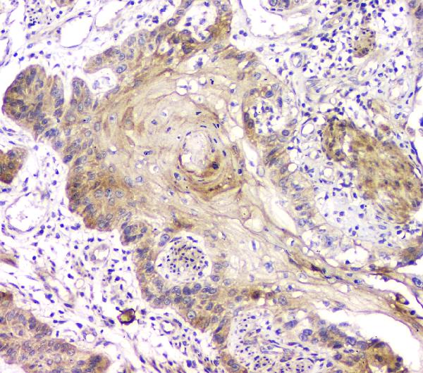 IHC analysis of RAB11B using anti-RAB11B antibody (A04526-1). RAB11B was detected in paraffin-embedded section of human oesophagus squama cancer tissue. Heat mediated antigen retrieval was performed in citrate buffer (pH6, epitope retrieval solution) for 20 mins. The tissue section was blocked with 10% goat serum. The tissue section was then incubated with 1μg/ml rabbit anti-RAB11B Antibody (A04526-1) overnight at 4°C. Biotinylated goat anti-rabbit IgG was used as secondary antibody and incubated for 30 minutes at 37°C. The tissue section was developed using Strepavidin-Biotin-Complex (SABC)(Catalog # SA1022) with DAB as the chromogen.