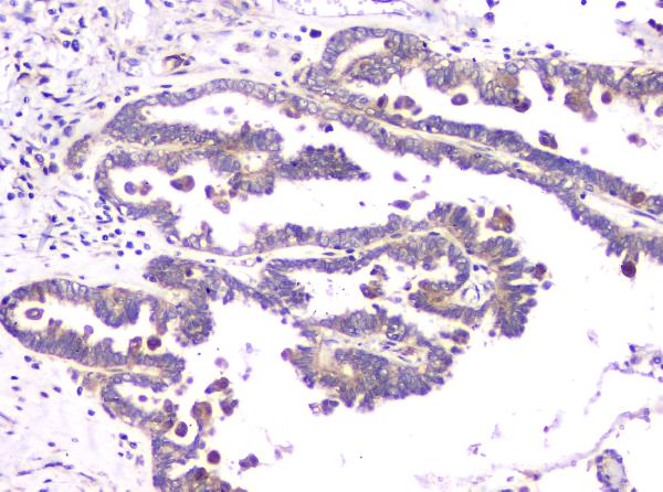 IHC analysis of RAB11B using anti-RAB11B antibody (A04526-1). RAB11B was detected in paraffin-embedded section of human ovary cancer tissue. Heat mediated antigen retrieval was performed in citrate buffer (pH6, epitope retrieval solution) for 20 mins. The tissue section was blocked with 10% goat serum. The tissue section was then incubated with 1μg/ml rabbit anti-RAB11B Antibody (A04526-1) overnight at 4°C. Biotinylated goat anti-rabbit IgG was used as secondary antibody and incubated for 30 minutes at 37°C. The tissue section was developed using Strepavidin-Biotin-Complex (SABC)(Catalog # SA1022) with DAB as the chromogen.