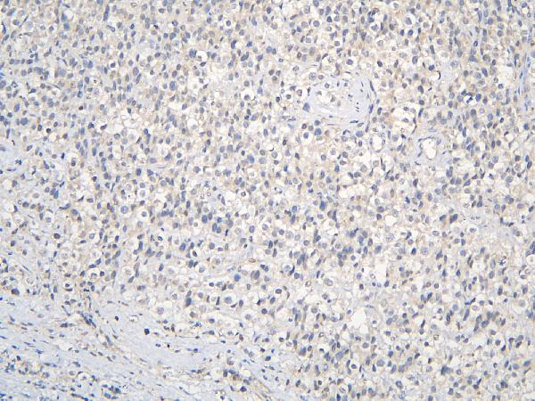 IHC analysis of CCDC36 using anti-CCDC36 antibody (A14775). CCDC36 was detected in paraffin-embedded section of human testis cancer tissue. Heat mediated antigen retrieval was performed in citrate buffer (pH6, epitope retrieval solution) for 20 mins. The tissue section was blocked with 10% goat serum. The tissue section was then incubated with 1μg/ml rabbit anti-CCDC36 Antibody (A14775) overnight at 4°C. Biotinylated goat anti-rabbit IgG was used as secondary antibody and incubated for 30 minutes at 37°C. The tissue section was developed using Strepavidin-Biotin-Complex (SABC)(Catalog # SA1022) with DAB as the chromogen.