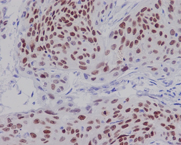 Immunohistochemical analysis of paraffin-embedded human cervix carcinoma, using SOX2 Antibody.