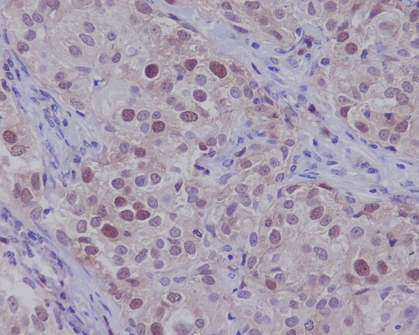 Immunohistochemical analysis of paraffin-embedded human beast carcinoma, using CDK2 Antibody.