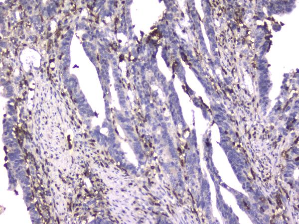 IHC analysis of CD18 using anti-CD18 antibody (M00458-1). CD18 was detected in paraffin-embedded section of human rectal cancer tissue. Heat mediated antigen retrieval was performed in citrate buffer (pH6, epitope retrieval solution) for 20 mins. The tissue section was blocked with 10% goat serum. The tissue section was then incubated with 2μg/ml mouse anti-CD18 Antibody (M00458-1) overnight at 4°C. Biotinylated goat anti-mouse IgG was used as secondary antibody and incubated for 30 minutes at 37°C. The tissue section was developed using Strepavidin-Biotin-Complex (SABC)(Catalog # SA1021) with DAB as the chromogen.