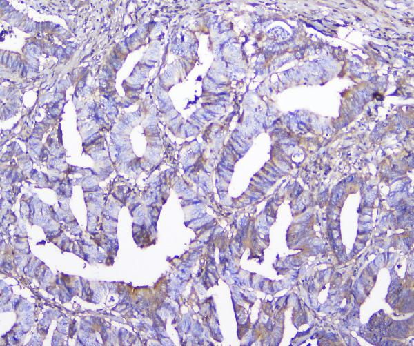 IHC analysis of GSTM1 using anti-GSTM1 antibody (M00569). GSTM1 was detected in paraffin-embedded section of human colon cancer tissue. Heat mediated antigen retrieval was performed in citrate buffer (pH6, epitope retrieval solution) for 20 mins. The tissue section was blocked with 10% goat serum. The tissue section was then incubated with 2μg/ml mouse anti-GSTM1 Antibody (M00569) overnight at 4°C. Biotinylated goat anti-mouse IgG was used as secondary antibody and incubated for 30 minutes at 37°C. The tissue section was developed using Strepavidin-Biotin-Complex (SABC)(Catalog # SA1021) with DAB as the chromogen.