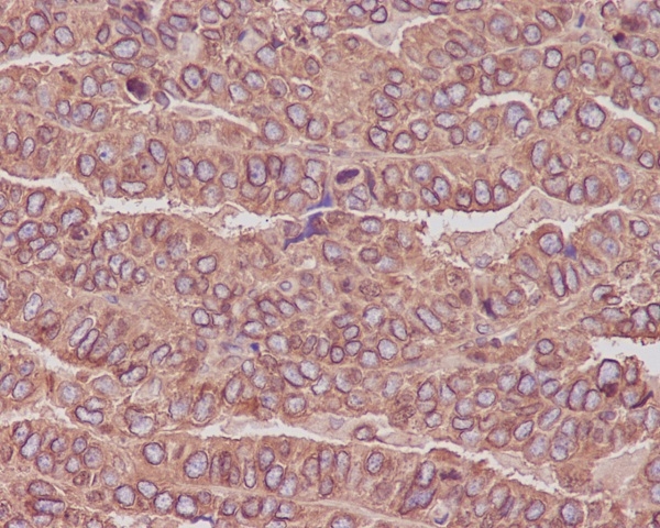 Immunohistochemical analysis of paraffin-embedded human ovarian cancer, using beta III Tubulin Antibody(M01857) TUBB3 was detected in paraffin-embedded tissue section. Heat mediated antigen retrieval was performed in citrate buffer (pH6, epitope retrieval solution) for 20 mins. The tissue section was blocked with 10% goat serum. The tissue section was then incubated with 1ug/ml rabbit anti-TUBB3 Antibody (M01857)overnight at 4 Biotinylated goat anti-rabbit IgG was used as secondary antibody and incubated for 30 minutes at 37 The tissue section was developed using Strepavidin-Biotin-Complex (SABC)(Catalog # SA1022) with DAB as the chromogen.