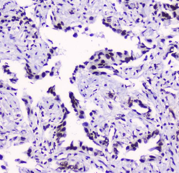 IHC analysis of SMC3 using anti-SMC3 antibody (M01930-1). SMC3 was detected in paraffin-embedded section of human lung cancer tissue. Heat mediated antigen retrieval was performed in citrate buffer (pH6, epitope retrieval solution) for 20 mins. The tissue section was blocked with 10% goat serum. The tissue section was then incubated with 2μg/ml mouse anti-SMC3 Antibody (M01930-1) overnight at 4°C. Biotinylated goat anti-mouse IgG was used as secondary antibody and incubated for 30 minutes at 37°C. The tissue section was developed using Strepavidin-Biotin-Complex (SABC)(Catalog # SA1021) with DAB as the chromogen.