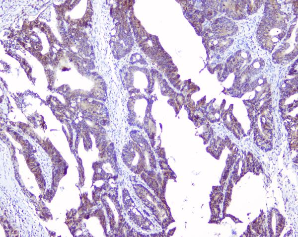 IHC analysis of SRI using anti-SRI antibody (A00222). SRI was detected in paraffin-embedded section of human intestinal cancer tissues. Heat mediated antigen retrieval was performed in citrate buffer (pH6, epitope retrieval solution) for 20 mins. The tissue section was blocked with 10% goat serum. The tissue section was then incubated with 1μg/ml rabbit anti-SRI Antibody (A00222) overnight at 4°C. Biotinylated goat anti-rabbit IgG was used as secondary antibody and incubated for 30 minutes at 37°C. The tissue section was developed using Strepavidin-Biotin-Complex (SABC)(Catalog # SA1022) with DAB as the chromogen.