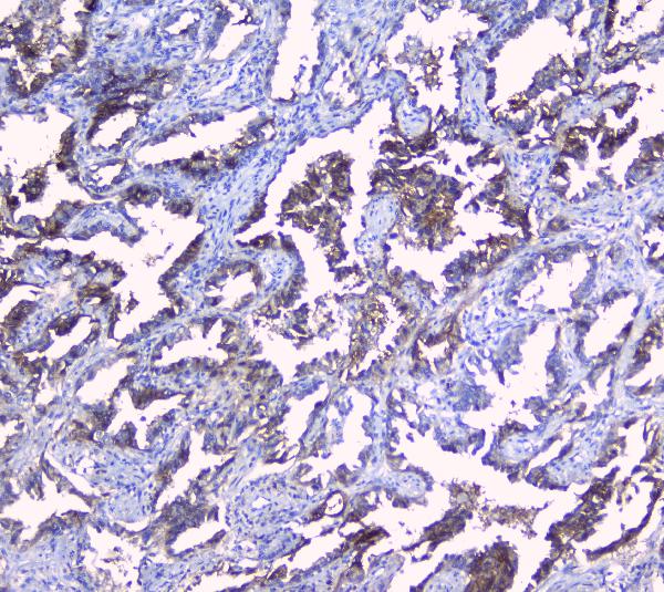 IHC analysis of SRI using anti-SRI antibody (A00222). SRI was detected in paraffin-embedded section of human lung cancer tissues. Heat mediated antigen retrieval was performed in citrate buffer (pH6, epitope retrieval solution) for 20 mins. The tissue section was blocked with 10% goat serum. The tissue section was then incubated with 1μg/ml rabbit anti-SRI Antibody (A00222) overnight at 4°C. Biotinylated goat anti-rabbit IgG was used as secondary antibody and incubated for 30 minutes at 37°C. The tissue section was developed using Strepavidin-Biotin-Complex (SABC)(Catalog # SA1022) with DAB as the chromogen.