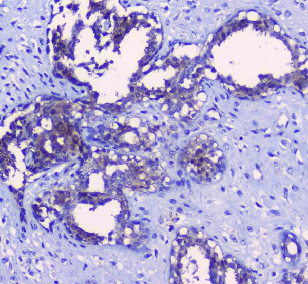 IHC analysis of SRI using anti-SRI antibody (A00222). SRI was detected in paraffin-embedded section of human mammary cancer tissues. Heat mediated antigen retrieval was performed in citrate buffer (pH6, epitope retrieval solution) for 20 mins. The tissue section was blocked with 10% goat serum. The tissue section was then incubated with 1μg/ml rabbit anti-SRI Antibody (A00222) overnight at 4°C. Biotinylated goat anti-rabbit IgG was used as secondary antibody and incubated for 30 minutes at 37°C. The tissue section was developed using Strepavidin-Biotin-Complex (SABC)(Catalog # SA1022) with DAB as the chromogen.