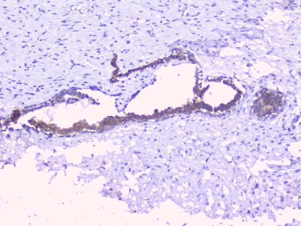 IHC analysis of PTP1B using anti-PTP1B antibody (A00613-1). PTP1B was detected in paraffin-embedded section of human mammary cancer tissues. Heat mediated antigen retrieval was performed in citrate buffer (pH6, epitope retrieval solution) for 20 mins. The tissue section was blocked with 10% goat serum. The tissue section was then incubated with 1μg/ml rabbit anti-PTP1B Antibody (A00613-1) overnight at 4°C. Biotinylated goat anti-rabbit IgG was used as secondary antibody and incubated for 30 minutes at 37°C. The tissue section was developed using Strepavidin-Biotin-Complex (SABC)(Catalog # SA1022) with DAB as the chromogen.