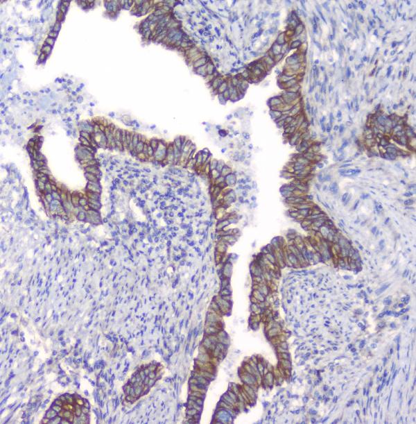 IHC analysis of PKC beta 1 using anti-PKC beta 1 antibody (A01940). PKC beta 1 was detected in paraffin-embedded section of human intestinal cancer tissues. Heat mediated antigen retrieval was performed in citrate buffer (pH6, epitope retrieval solution) for 20 mins. The tissue section was blocked with 10% goat serum. The tissue section was then incubated with 1μg/ml rabbit anti-PKC beta 1 Antibody (A01940) overnight at 4°C. Biotinylated goat anti-rabbit IgG was used as secondary antibody and incubated for 30 minutes at 37°C. The tissue section was developed using Strepavidin-Biotin-Complex (SABC)(Catalog # SA1022) with DAB as the chromogen.