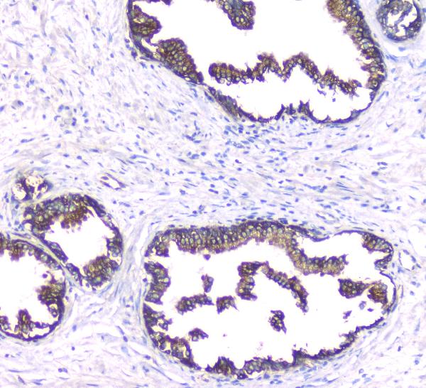 IHC analysis of PKC beta 1 using anti-PKC beta 1 antibody (A01940). PKC beta 1 was detected in paraffin-embedded section of human prostatic cancer tissues. Heat mediated antigen retrieval was performed in citrate buffer (pH6, epitope retrieval solution) for 20 mins. The tissue section was blocked with 10% goat serum. The tissue section was then incubated with 1μg/ml rabbit anti-PKC beta 1 Antibody (A01940) overnight at 4°C. Biotinylated goat anti-rabbit IgG was used as secondary antibody and incubated for 30 minutes at 37°C. The tissue section was developed using Strepavidin-Biotin-Complex (SABC)(Catalog # SA1022) with DAB as the chromogen.
