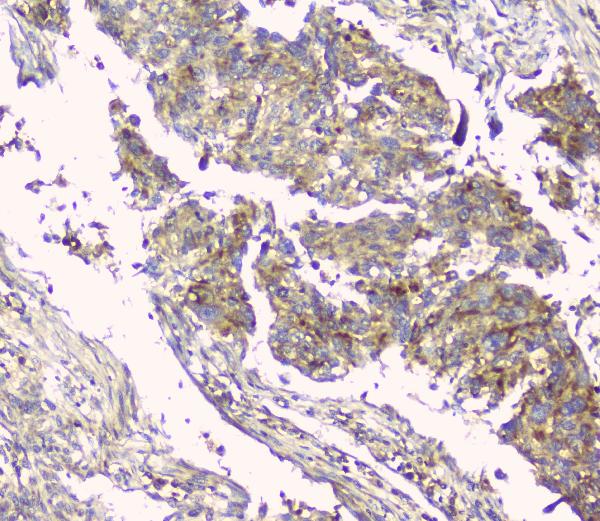 IHC analysis of HAS1 using anti-HAS1 antibody (A04784-1). HAS1 was detected in paraffin-embedded section of human lung cancer tissue. Heat mediated antigen retrieval was performed in citrate buffer (pH6, epitope retrieval solution) for 20 mins. The tissue section was blocked with 10% goat serum. The tissue section was then incubated with 1ugμg/ml rabbit anti-HAS1 Antibody (A04784-1) overnight at 4°C. Biotinylated goat anti-rabbit IgG was used as secondary antibody and incubated for 30 minutes at 37°C. The tissue section was developed using Strepavidin-Biotin-Complex (SABC)(Catalog # SA1022) with DAB as the chromogen.