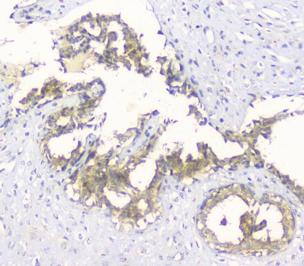 IHC analysis of HAS1 using anti-HAS1 antibody (A04784-1). HAS1 was detected in paraffin-embedded section of human mammary cancer tissue. Heat mediated antigen retrieval was performed in citrate buffer (pH6, epitope retrieval solution) for 20 mins. The tissue section was blocked with 10% goat serum. The tissue section was then incubated with 1ugμg/ml rabbit anti-HAS1 Antibody (A04784-1) overnight at 4°C. Biotinylated goat anti-rabbit IgG was used as secondary antibody and incubated for 30 minutes at 37°C. The tissue section was developed using Strepavidin-Biotin-Complex (SABC)(Catalog # SA1022) with DAB as the chromogen.