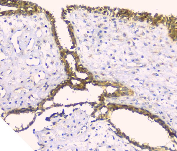 IHC analysis of HAS1 using anti-HAS1 antibody (A04784-1). HAS1 was detected in paraffin-embedded section of human mammary cancer tissue. Heat mediated antigen retrieval was performed in citrate buffer (pH6, epitope retrieval solution) for 20 mins. The tissue section was blocked with 10% goat serum. The tissue section was then incubated with 1ugμg/ml rabbit anti-HAS1 Antibody (A04784-1) overnight at 4°C. Biotinylated goat anti-rabbit IgG was used as secondary antibody and incubated for 30 minutes at 37°C. The tissue section was developed using Strepavidin-Biotin-Complex (SABC)(Catalog # SA1022) with DAB as the chromogen.