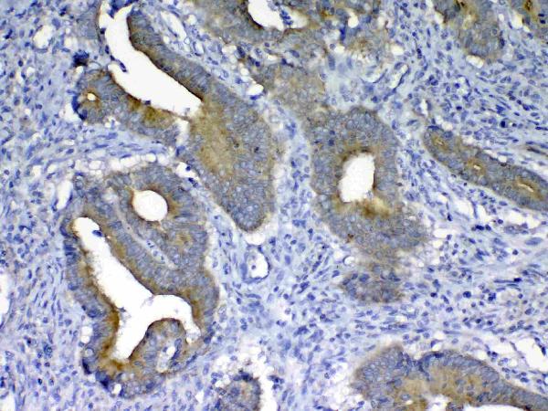 IHC analysis of MMP10 using anti-MMP10 antibody (A03759-1). MMP10 was detected in paraffin-embedded section of human colon cancer tissue. Heat mediated antigen retrieval was performed in citrate buffer (pH6, epitope retrieval solution) for 20 mins. The tissue section was blocked with 10% goat serum. The tissue section was then incubated with 1μg/ml rabbit anti-MMP10 Antibody (A03759-1) overnight at 4°C. Biotinylated goat anti-rabbit IgG was used as secondary antibody and incubated for 30 minutes at 37°C. The tissue section was developed using Strepavidin-Biotin-Complex (SABC)(Catalog # SA1022) with DAB as the chromogen.