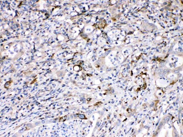 IHC analysis of Bax using anti-Bax antibody (A00183). Bax was detected in paraffin-embedded section of human intetsinal cancer tissues. Heat mediated antigen retrieval was performed in citrate buffer (pH6, epitope retrieval solution) for 20 mins. The tissue section was blocked with 10% goat serum. The tissue section was then incubated with 1μg/ml rabbit anti-Bax Antibody (A00183) overnight at 4°C. Biotinylated goat anti-rabbit IgG was used as secondary antibody and incubated for 30 minutes at 37°C. The tissue section was developed using Strepavidin-Biotin-Complex (SABC)(Catalog # SA1022) with DAB as the chromogen.