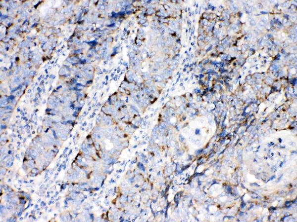 IHC analysis of Bax using anti-Bax antibody (A00183). Bax was detected in paraffin-embedded section of human lung cancer tissues. Heat mediated antigen retrieval was performed in citrate buffer (pH6, epitope retrieval solution) for 20 mins. The tissue section was blocked with 10% goat serum. The tissue section was then incubated with 1μg/ml rabbit anti-Bax Antibody (A00183) overnight at 4°C. Biotinylated goat anti-rabbit IgG was used as secondary antibody and incubated for 30 minutes at 37°C. The tissue section was developed using Strepavidin-Biotin-Complex (SABC)(Catalog # SA1022) with DAB as the chromogen.